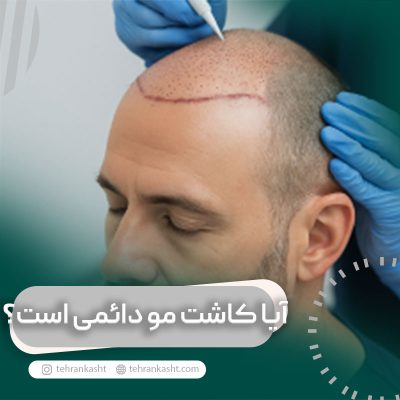 آیا کاشت مو دائمی است؟