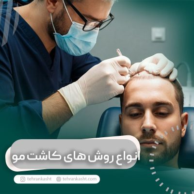 انواع روش های کاشت مو