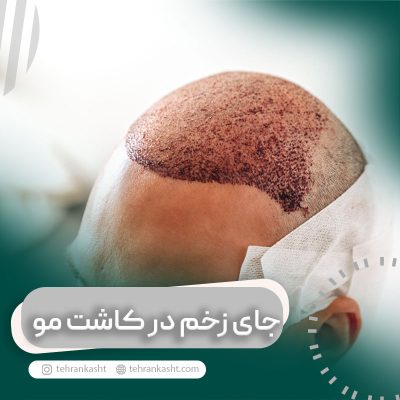 جای زخم در کاشت مو