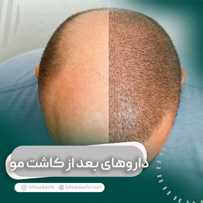 داروهای بعد از کاشت مو