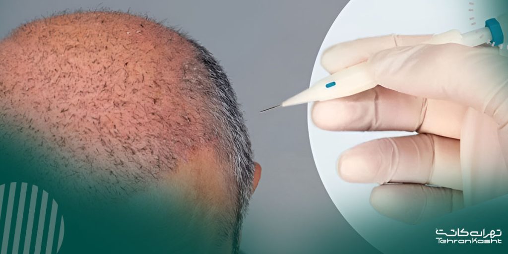 مقایسه روش‌های مختلف کاشت مو از نظر میزان زخم و اسکار