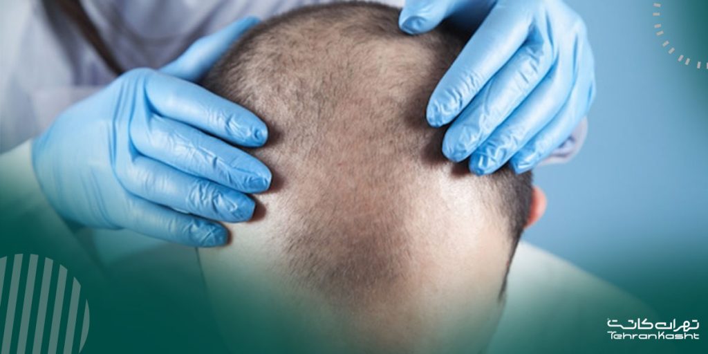 ریزش مجدد مو بعد از کاشت