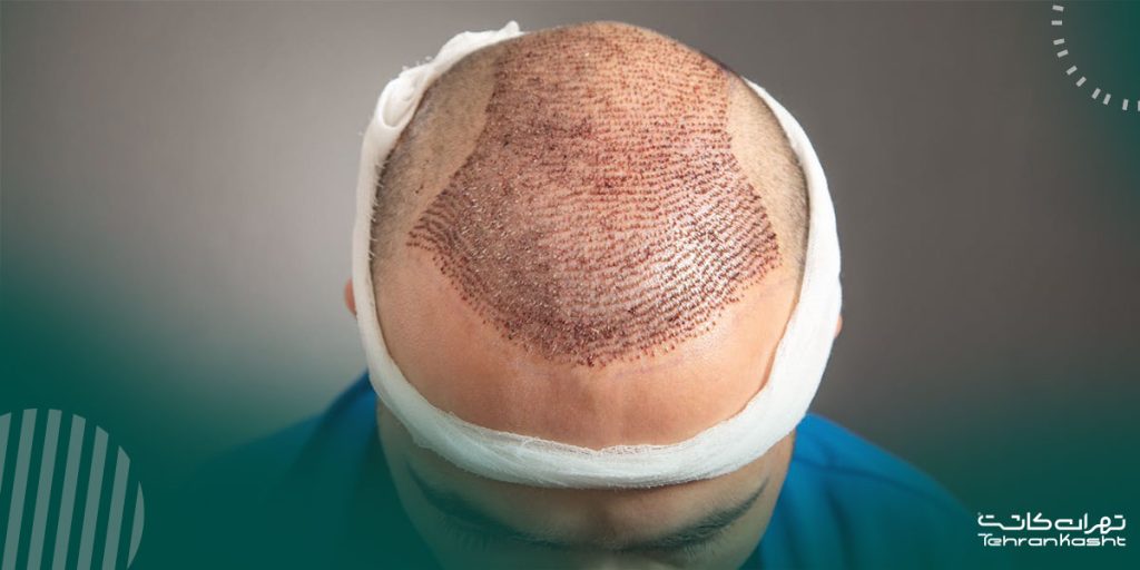 چگونه از ایجاد زخم در کاشت مو جلوگیری کنیم؟