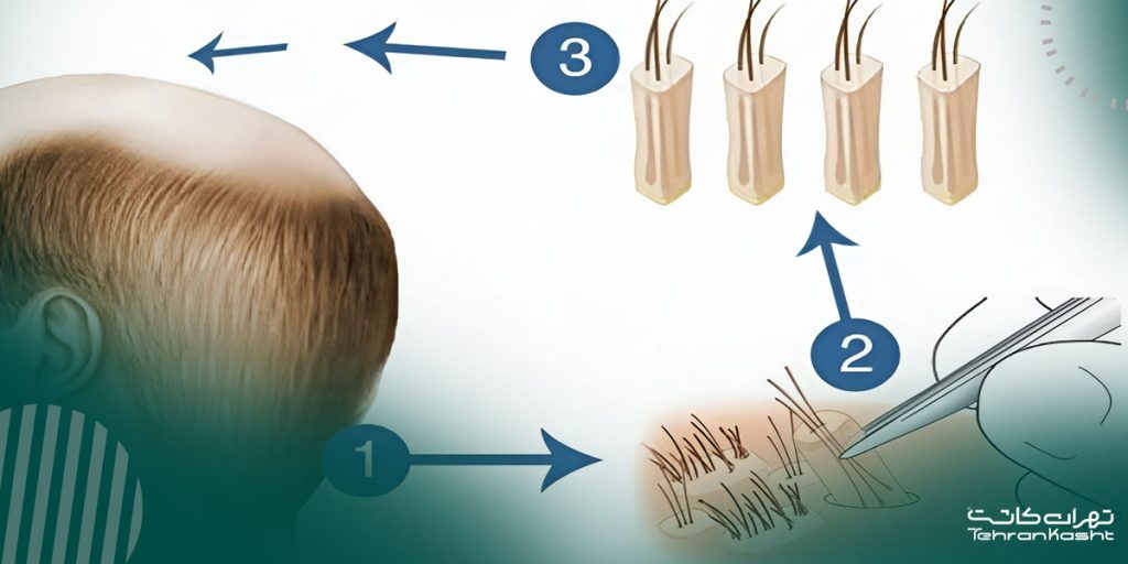 کاشت مو به روش FUE