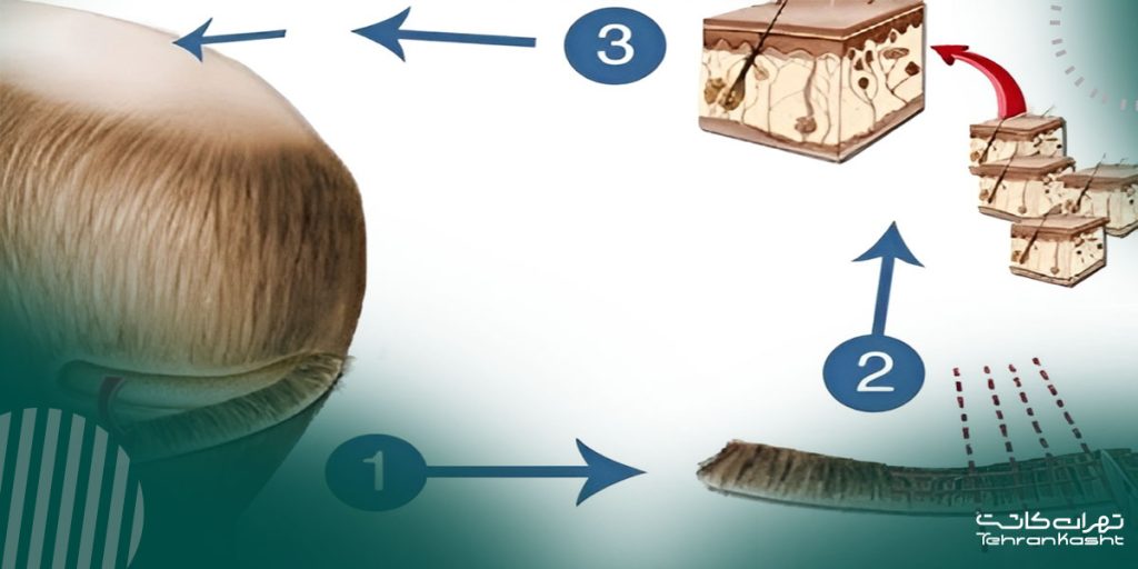 کاشت مو به روش FUT