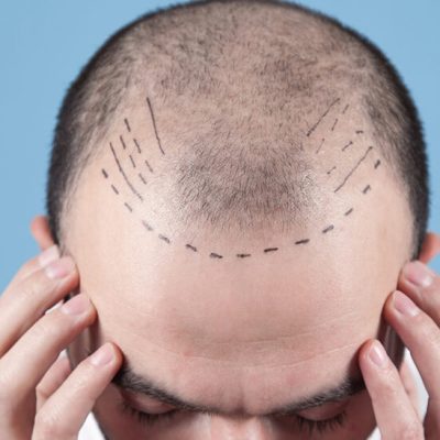 اشتباه بعد از کاشت مو