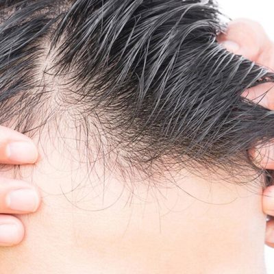 تلوژن افلوویوم چیست؟