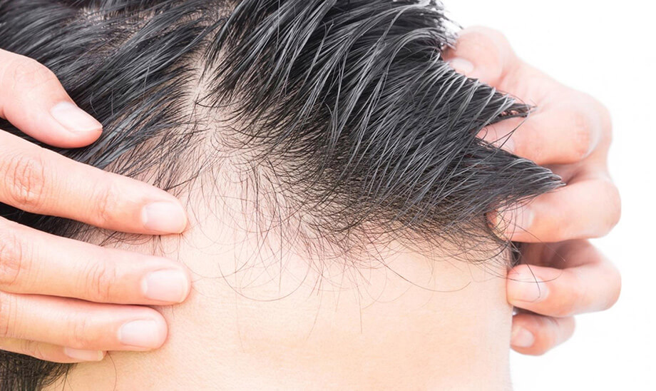 تلوژن افلوویوم چیست؟
