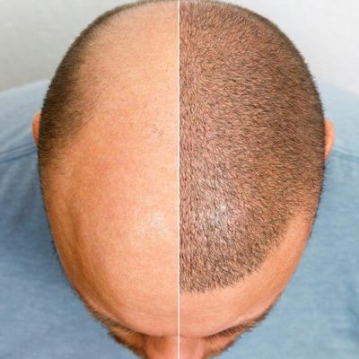 میکروپیگمنتیشن