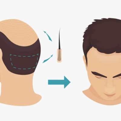 باورهای نادرست درباره کاشت مو
