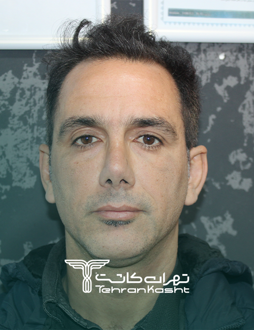 نمونه کار کاشت مو به روش sut