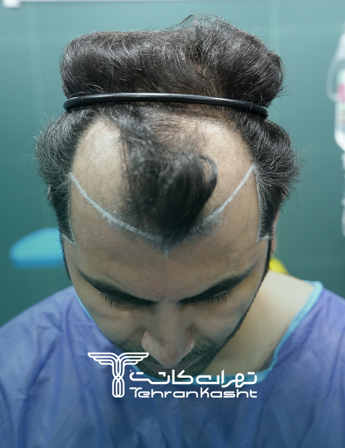 نمونه کار کاشت مو به روش sut