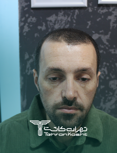 نمونه کار کاشت مو