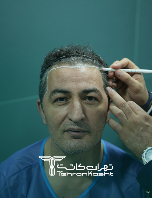 نمونه کار کاشت مو