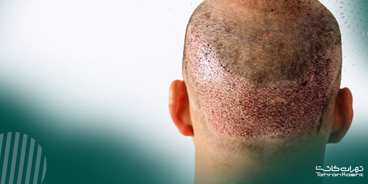 شایع‌ترین عوارض کاشت مو: علائم و مدت زمان بهبود