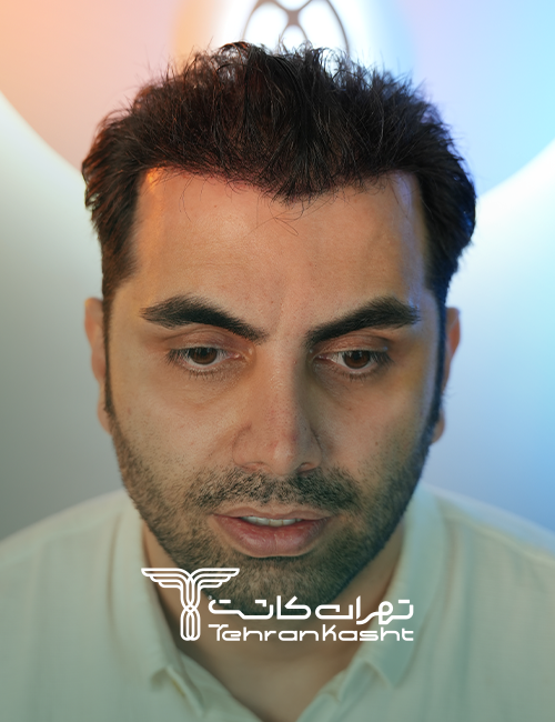 نمونه کار کاشت مو به روش sut