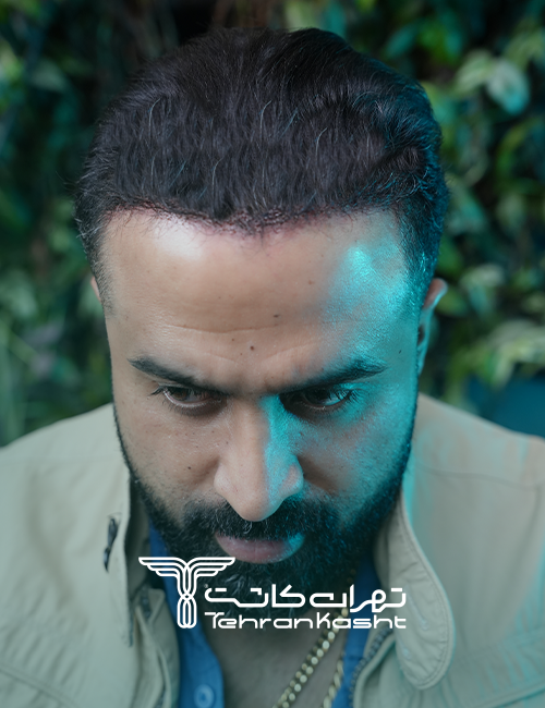 نمونه کار کاشت مو