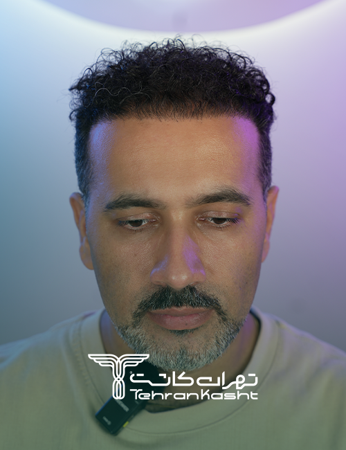 نمونه کار کاشت مو