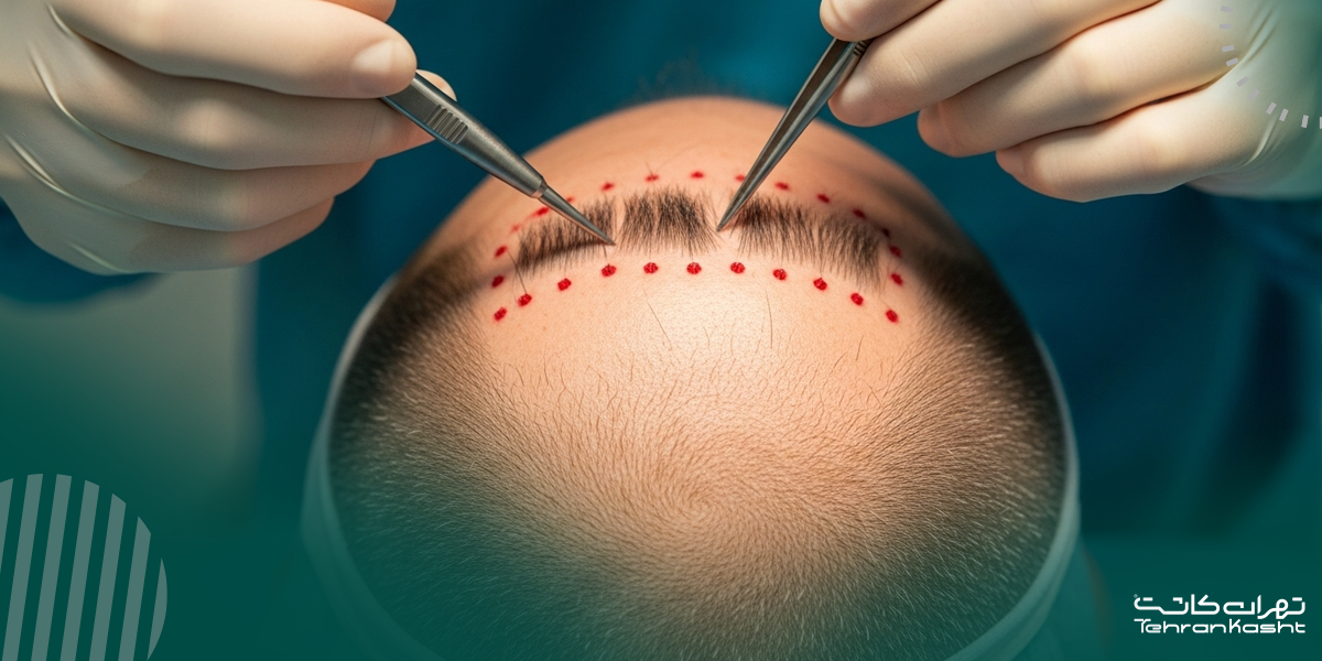 هزینه کاشت مو از ریش به سر: عوامل موثر و حدود قیمت