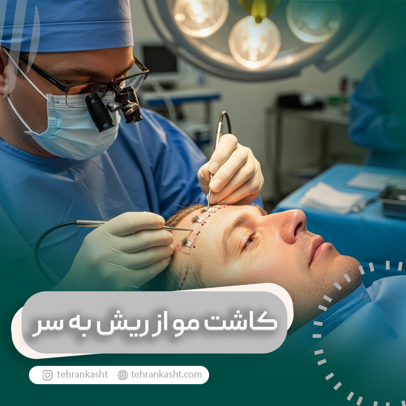 کاشت مو از ریش به سر