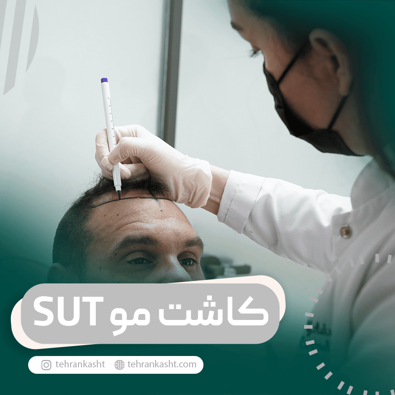 کاشت مو به روش sut