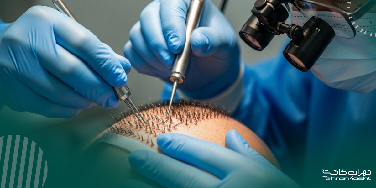 کاشت مو با سلول‌های بنیادی