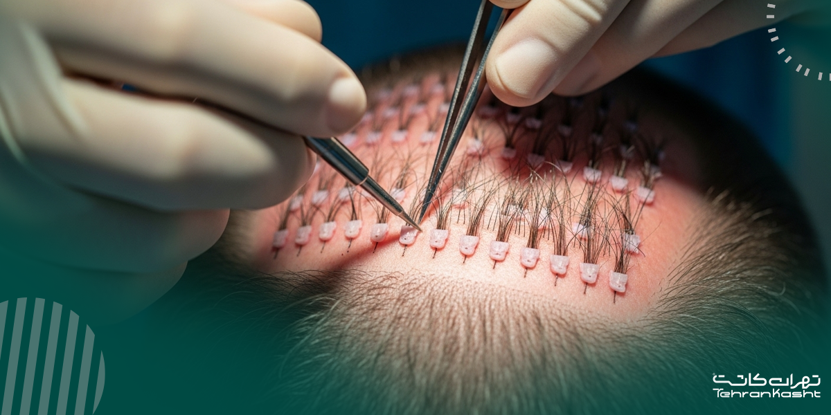 مراقبت‌های قبل و بعد از کاشت مو از ریش به سر
