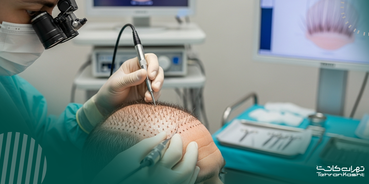 مقایسه روش‌ها کاشت مو