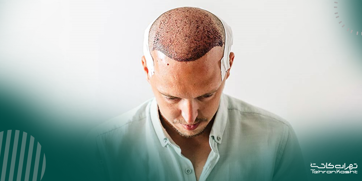 خالی شدن یا آسیب به بانک مو: پیامدهای برداشت بیش از حد