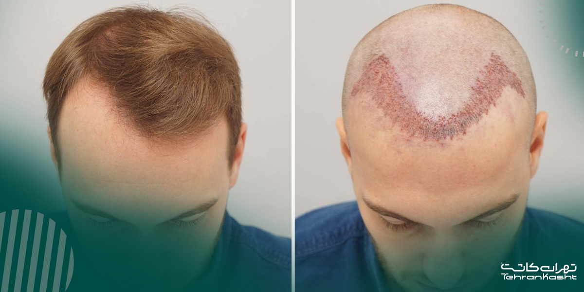 سوالات متداول (FAQ) درباره کاشت مو به روش FUE