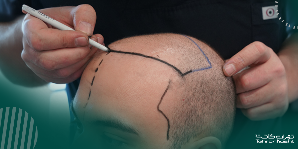آیا در کاشت مو به روش FUE موهای سر کاملا تراشیده میشوند؟