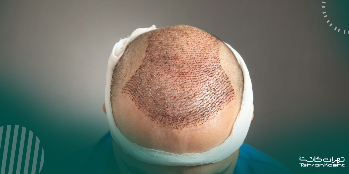 کاشت مستقیم فولیکول‌ها با قلم ایمپلنتر (چوی پن)