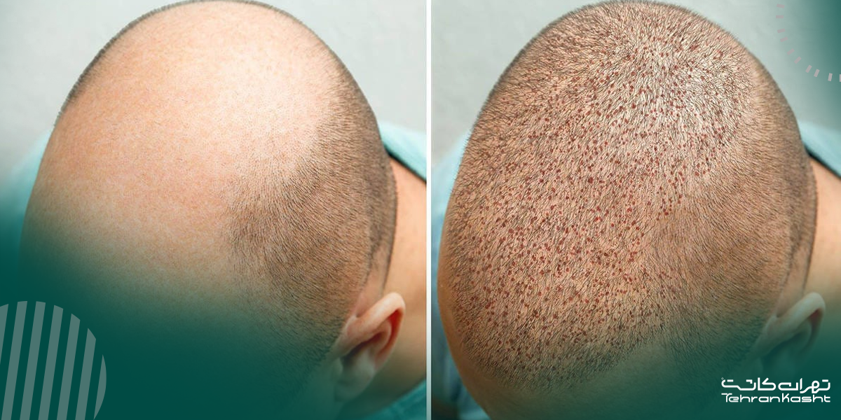 مراحل گام به گام کاشت مو به روش FUE