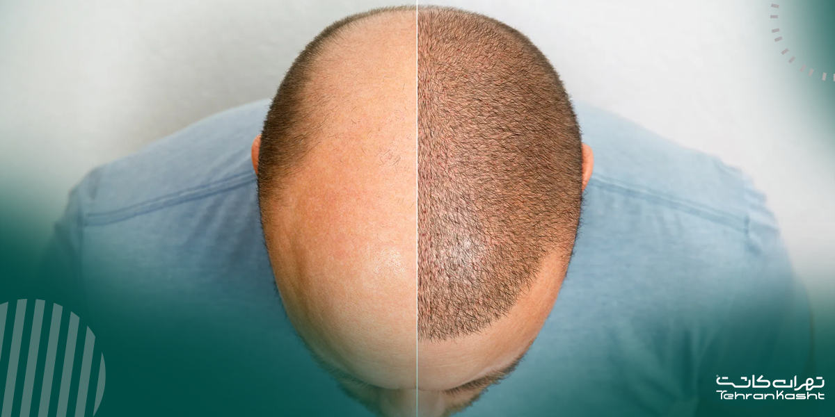 کاربردهای اصلی FUE