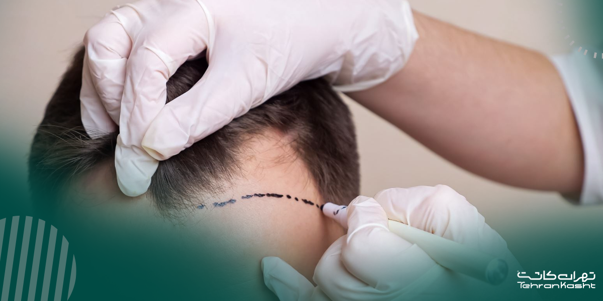 مزایا و معایب کاشت مو به روش FIT