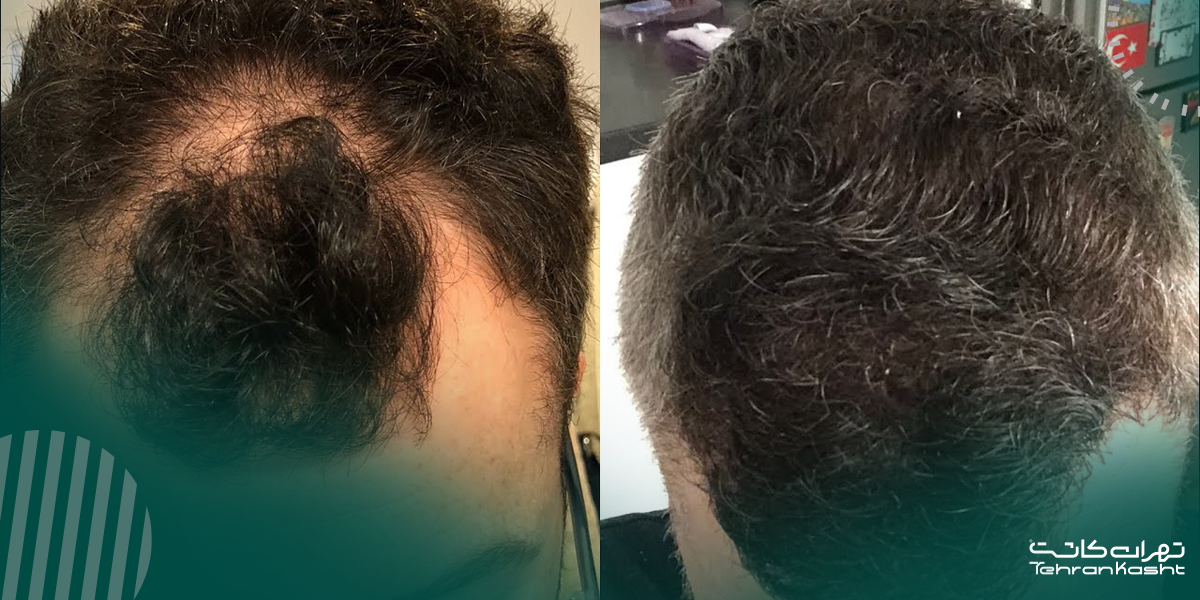 آمادگیهای لازم و مراقبتهای پس از کاشت BHT