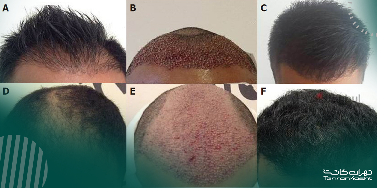 سوالات متداول در مورد کاشت مو به روش میکروگرافت