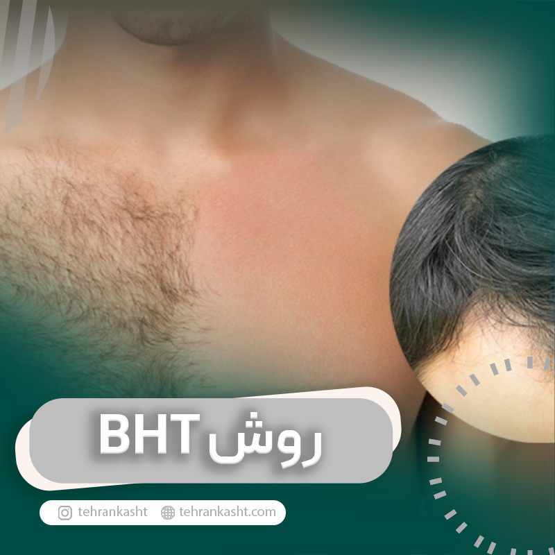 کاشت مو به روش BHT