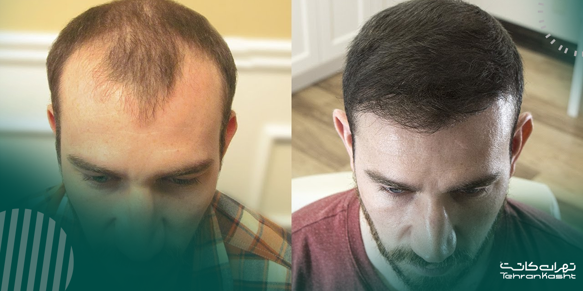 چگونگی انجام کاشت مو به روش BHT