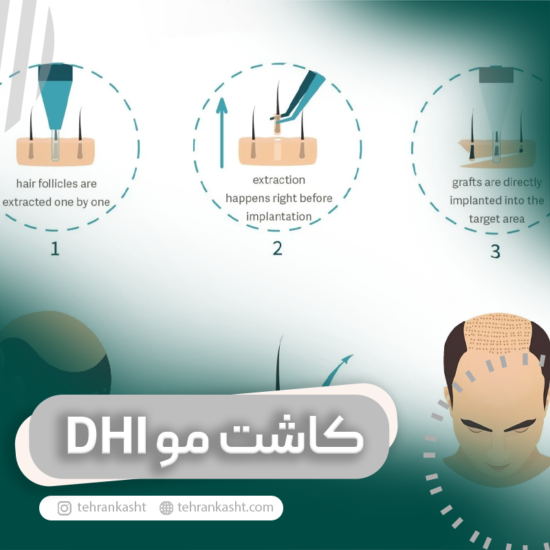 کاشت مو به روش DHI