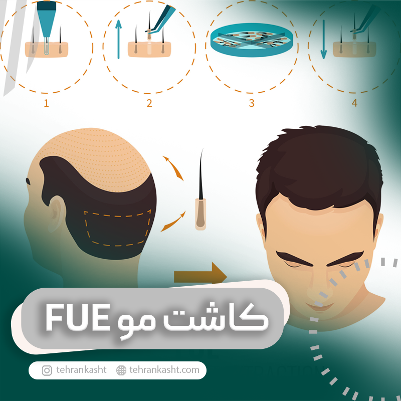 کاشت مو به روش FUE