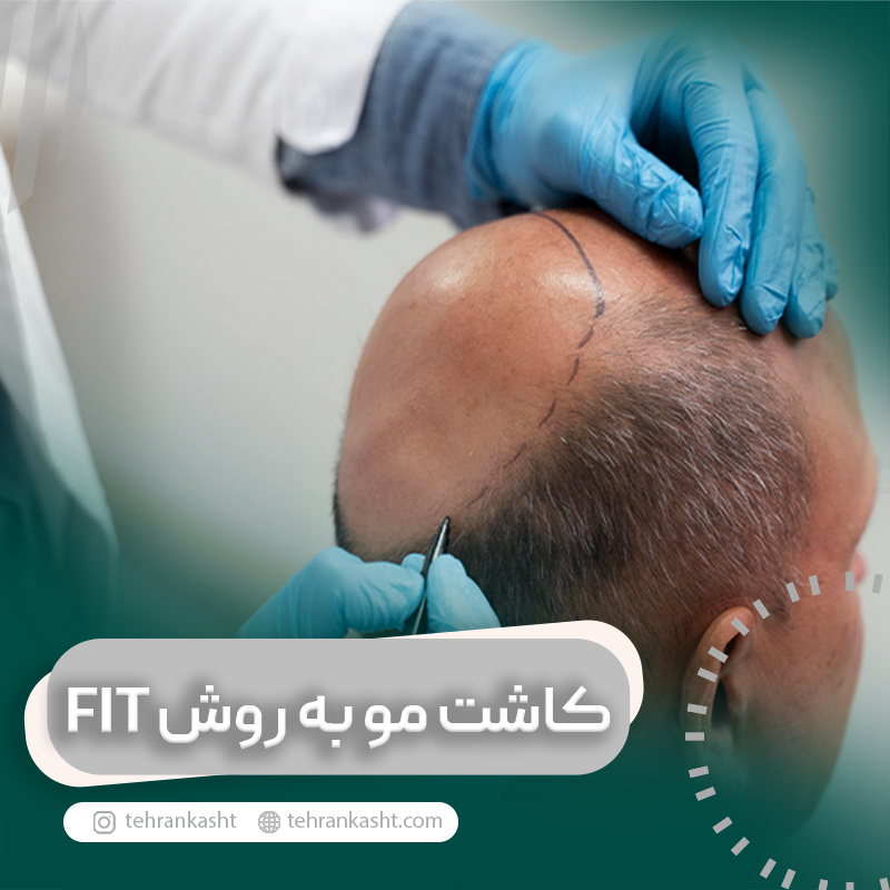 کاشت مو به روش FIT