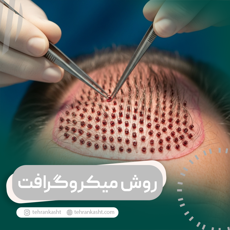 کاشت مو به روش میکروگرافت