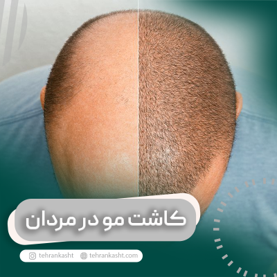 کاشت مو در مردان