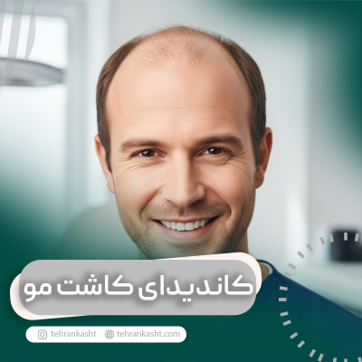 کاندیدای مناسب کاشت مو
