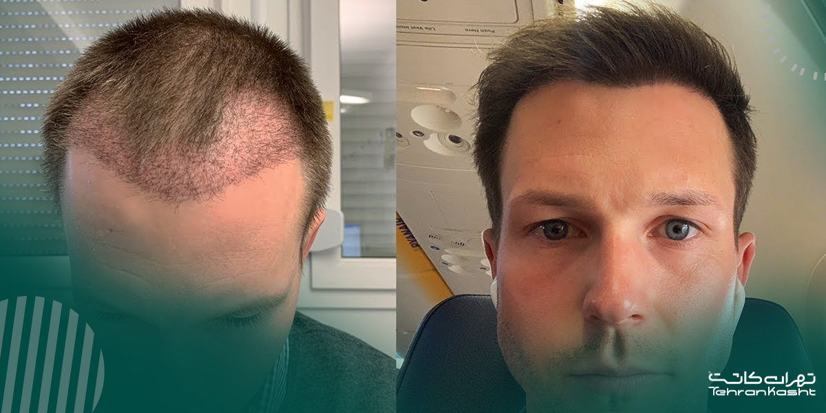 چه کسانی کاندیدای مناسب کاشت مو به روش BHT هستند؟ (و چه کسانی نیستند)