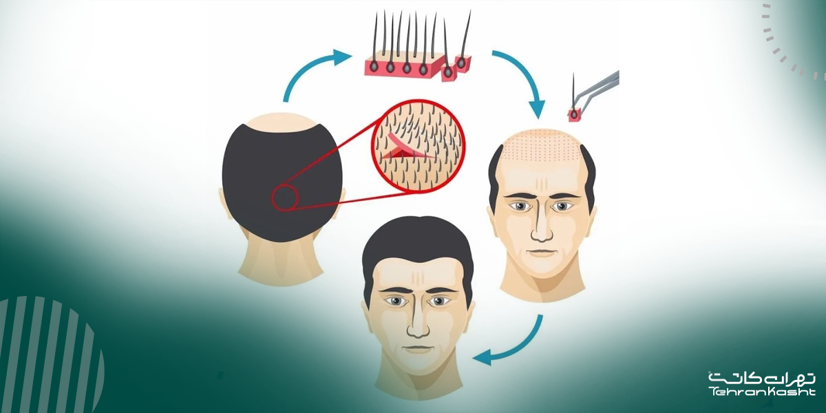 مراحل انجام کاشت مو به روش FIT