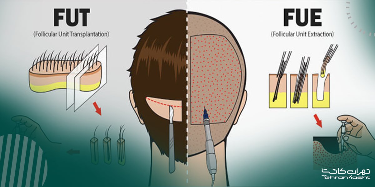 مزایای کاشت مو به روش fut
