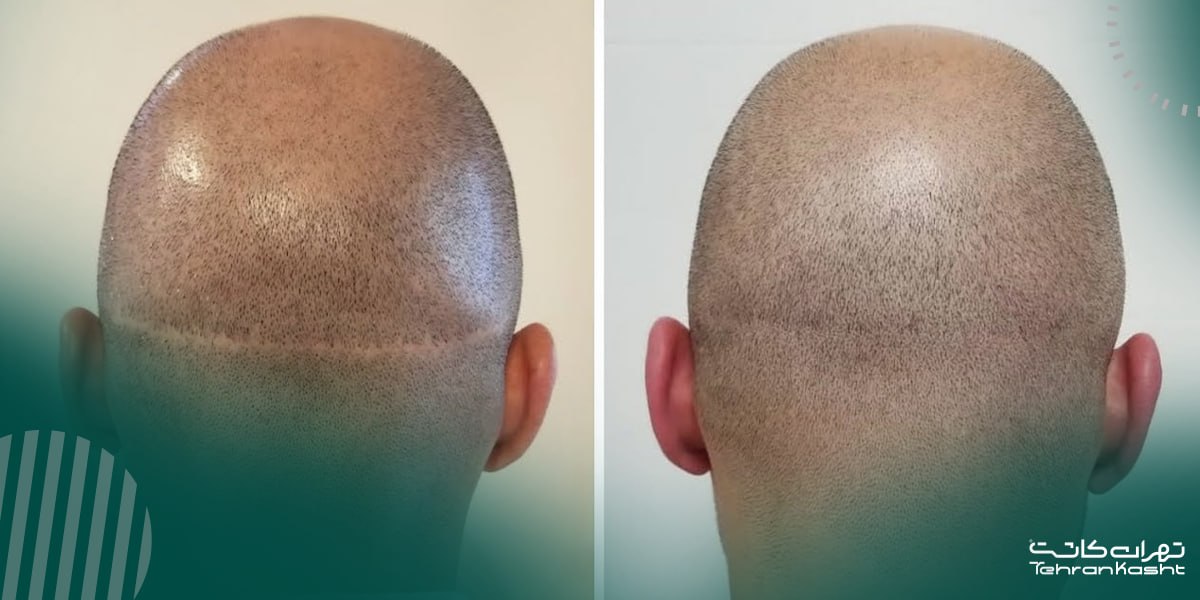 مزایای کاشت مو