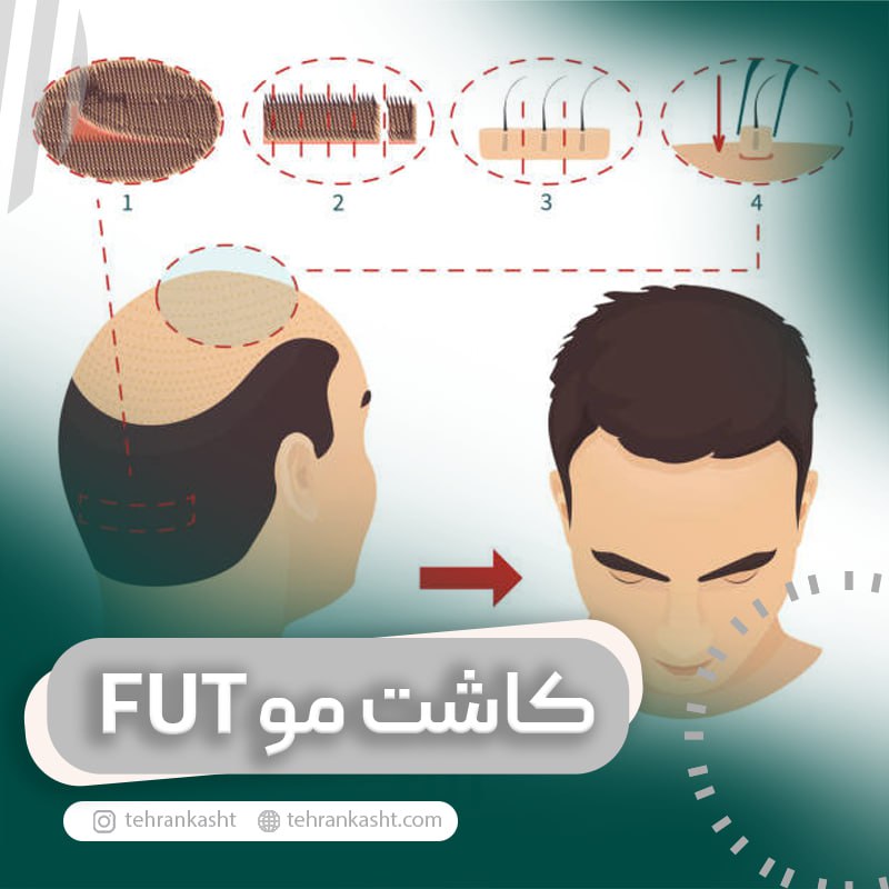 کاشت مو به روش fut